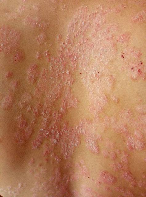 湿疹和皮癣的区别图片