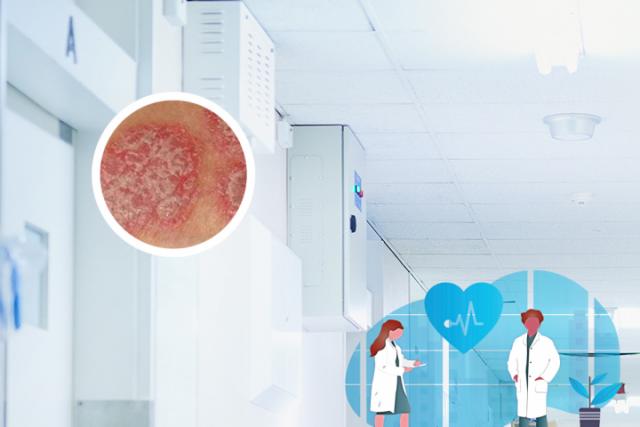 治疗脓疱型银屑病哪种方法有效