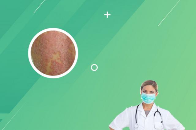 儿童疱疹型银屑病(儿童疱疹型牛皮癣)