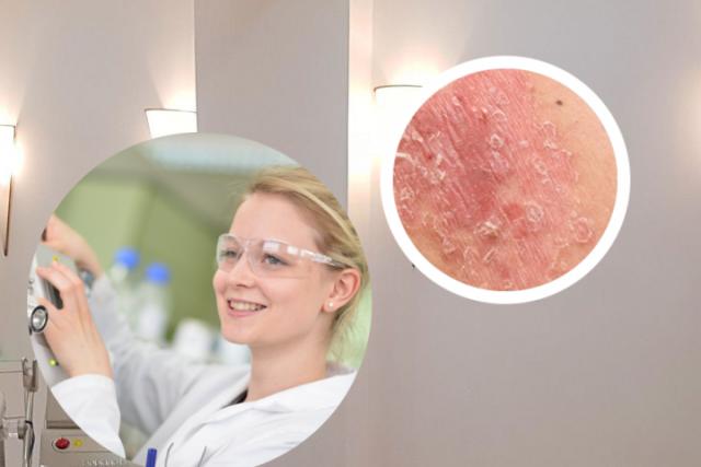 皮肤癣是什么原因造成的HIV
