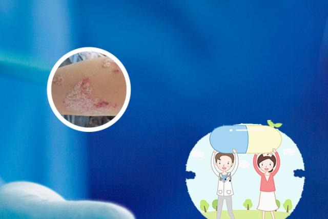 银屑病有什么病发症吗