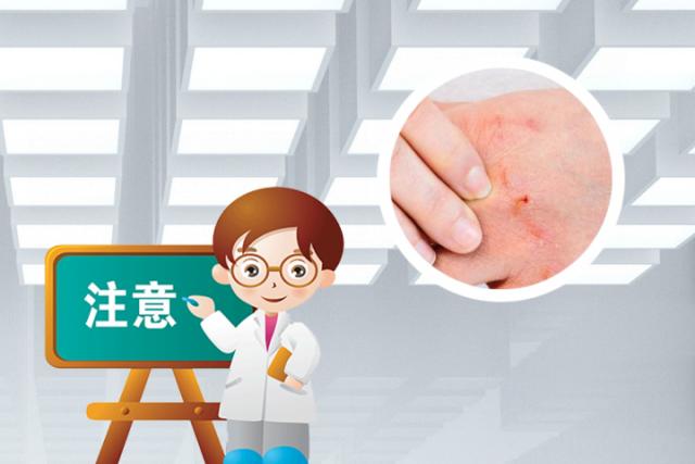 银屑病发展成关节炎需要几年
