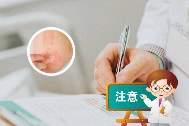 什么外用药治牛皮癣