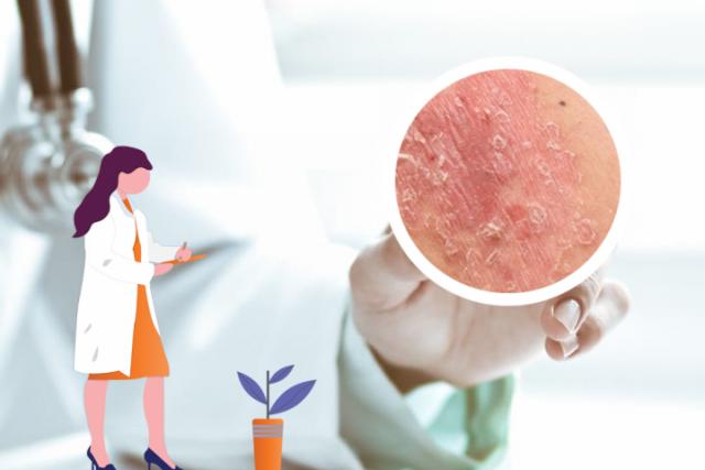 银屑治疗最好方法
