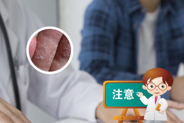 红斑狼疮和银屑病哪个严重