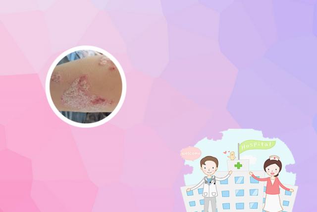 冶疗银屑病的偏方(银屑病的偏方冶疗)
