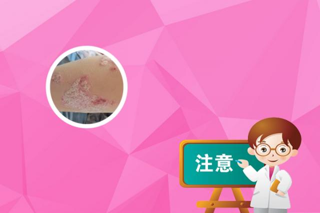 牛皮癣外用配方(牛皮癣外用中药配方)