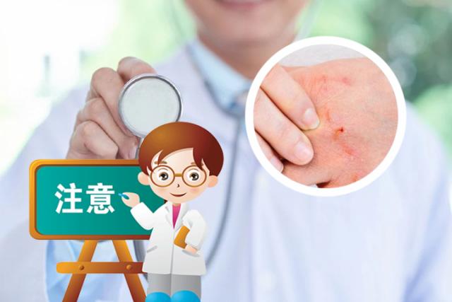 牛皮癣痒不痒