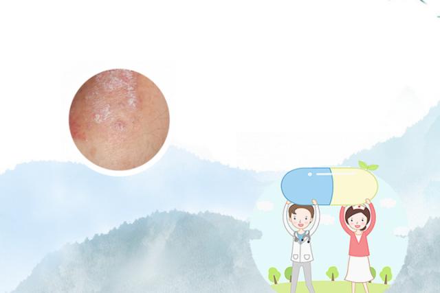 急性银屑病症状