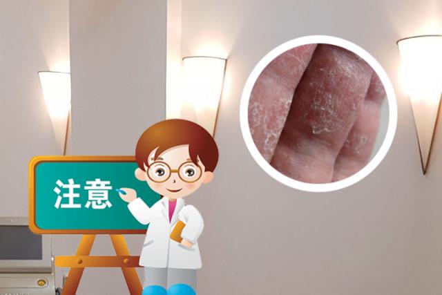 牛皮癣的发病原因是什么