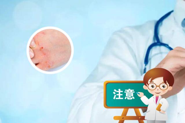 银屑病的外用药