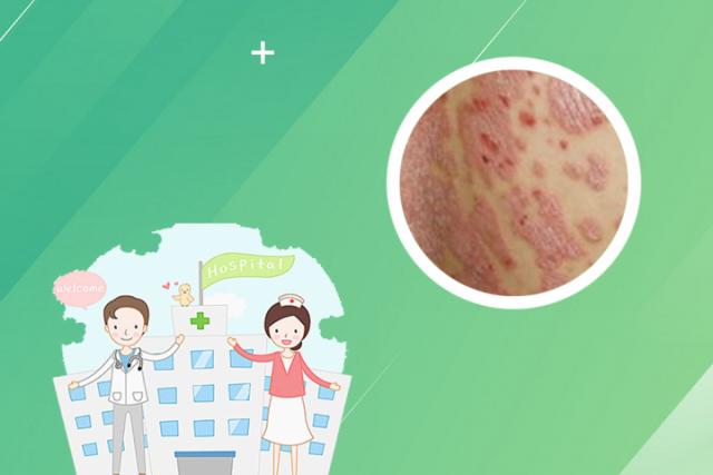 浓泡银屑病病人适合什么运动