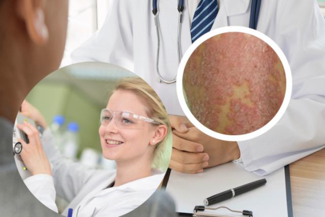 头皮银屑病是什么病菌