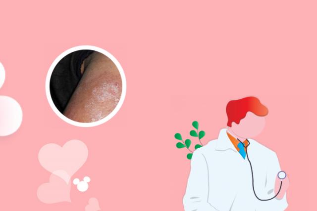 牛皮癣多发生于